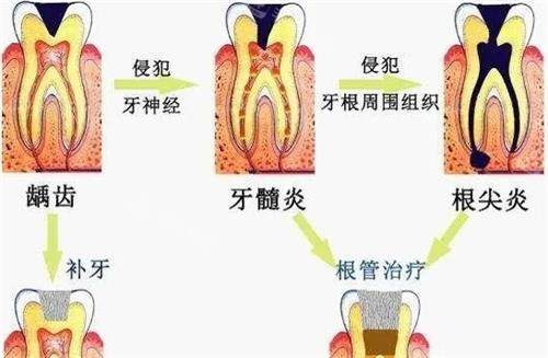 牙髓炎的治疗方法