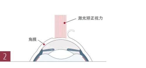 激光矫正手术示意图