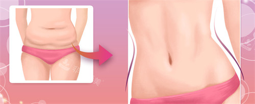 腹壁成形手术对比图