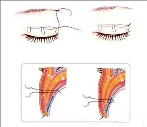 双眼皮手术原理
