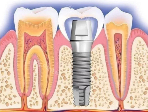 种植牙示意图1