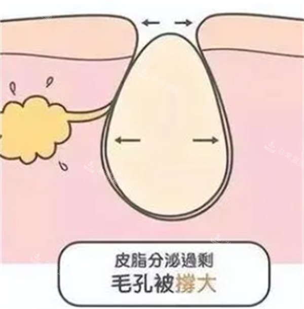 缺水形毛孔圖解