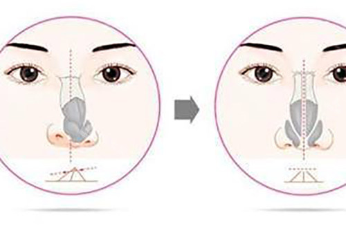 鼻矫正示意图