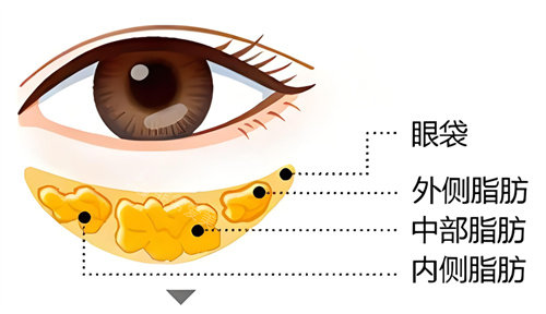 韩国做眼袋手术大概多少钱?我在韩国祛眼袋花了1万元但变化非常大!