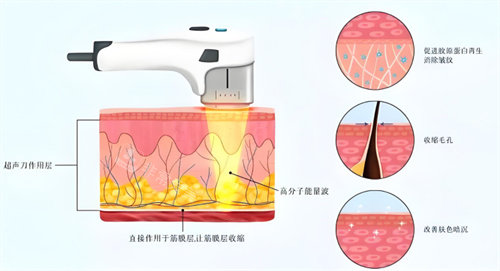 超声炮皮肤层原理