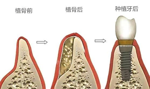 种植牙植骨前后于种植牙后漫画图