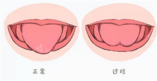 舌系带过短与正常舌头对比