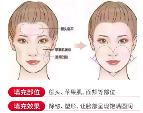 想知道西安自体脂肪填充哪个医院好?通过我在艺星整形做SVF黄金脂肪胶手术经历看看吧~