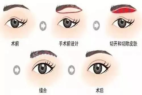 眉切法示意圖 眉切法示意圖