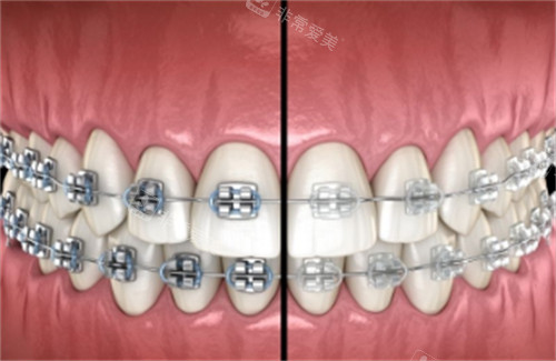 不同材质的牙齿矫正方式