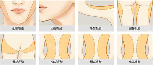 可以進行吸脂手術的部位展示動畫圖