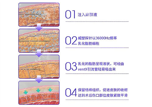 威塑吸脂手術(shù)步驟演示動畫圖