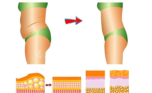 腰腹部吸脂術(shù)前后對比動畫圖