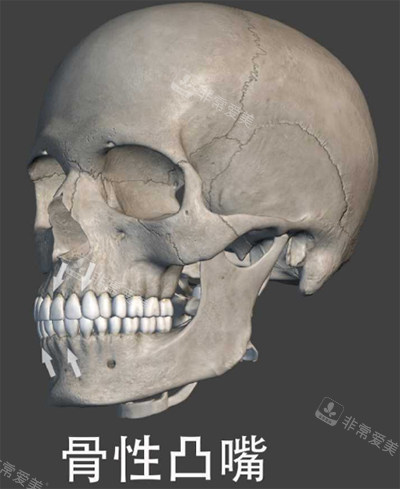 骨性凸嘴圖示 骨性凸嘴圖示