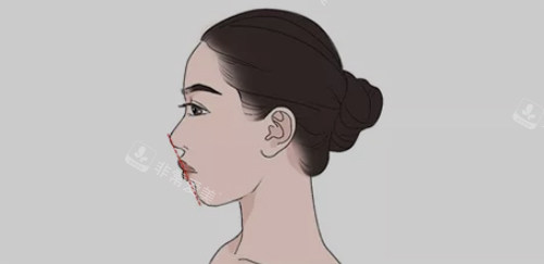 凸嘴的圖片 凸嘴的圖片