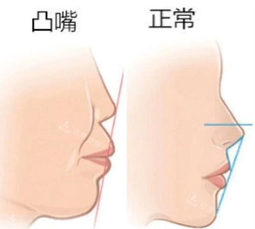 凸嘴与正常嘴型对比