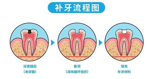 补牙的流程