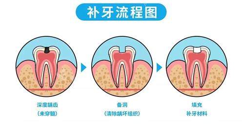 補牙的流程 補牙的流程