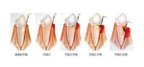 牙髓炎的發(fā)展過程 牙髓炎的發(fā)展過程
