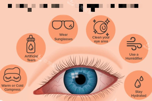 干眼症治疗方法