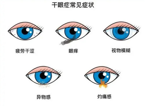 干眼癥常見癥狀 干眼癥常見癥狀