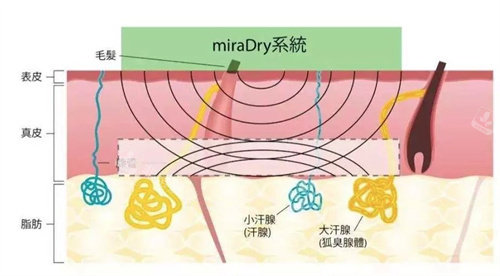 清新微波治疗狐臭原理