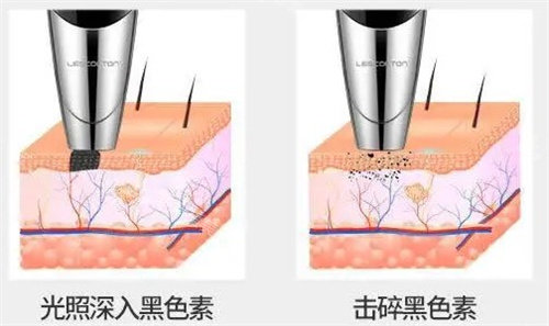 郑州洗纹身哪家好又不留疤?郑州洗纹身医院排名有京城皮肤医院/肤康皮肤病医院/美莱整形!