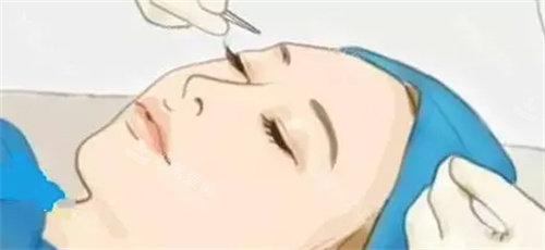 双眼皮手术过程卡通图