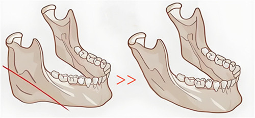 下颌骨切除步骤动画演示图