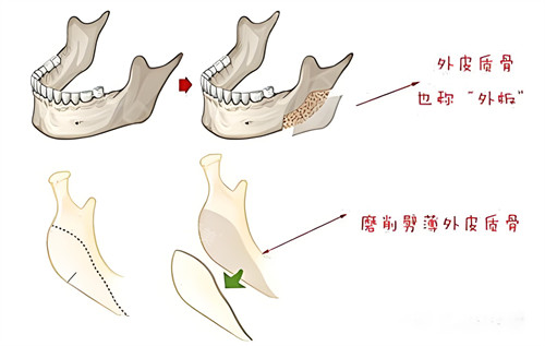 下颌骨切除术过程演示动画图