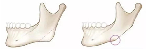下颌骨切除前后动画演示图