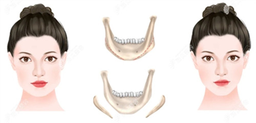 下颌骨截取手术前后对比图