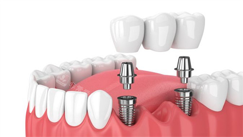 多颗种植牙图