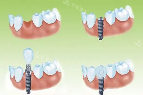 单颗种植牙种植过程卡通示意图