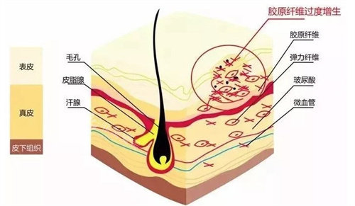 增生疤痕示意圖 增生疤痕示意圖