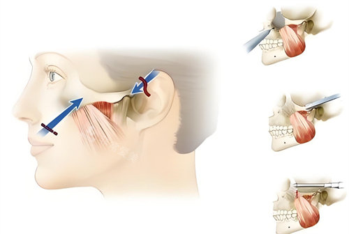 顴骨內(nèi)推手術原理動畫圖