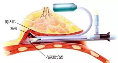 ​韩国做假体隆胸怎么样，分享我在韩国做假体隆胸手术的经历！