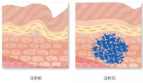 扒一扒:延安注射玻尿酸医院排名榜前十名有哪些?三家医院简介+价格表为你解答~