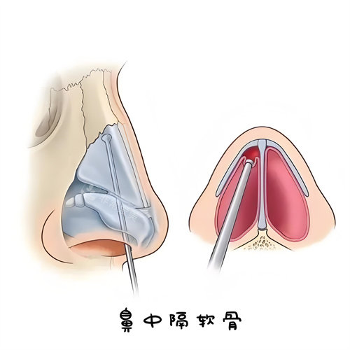 鼻中隔軟骨演示動畫圖