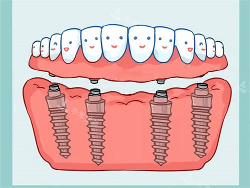 All-On-4全口种植牙漫画图