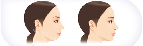 下巴內(nèi)縮手術(shù)前后對比動畫圖
