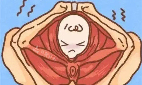缩阴手术卡通图 缩阴手术卡通图