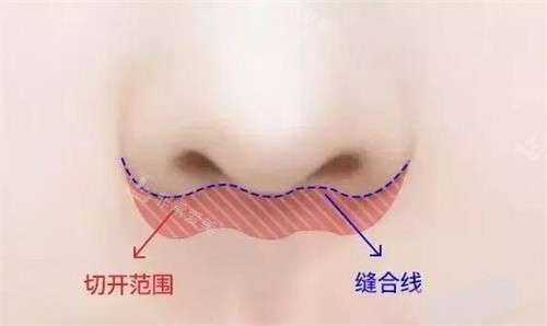 人中縮短卡通圖展示