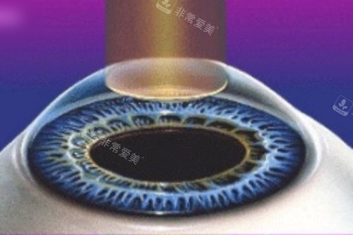 全激光手术