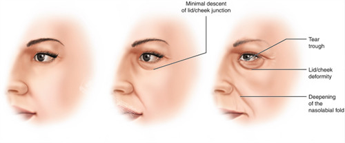 面部提升改善不同程度的面部老化