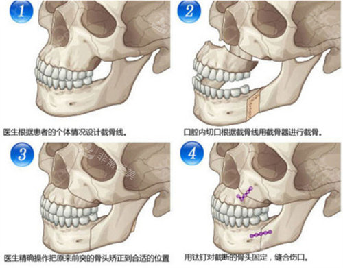 下颌骨矢状劈开术手术步骤演示图