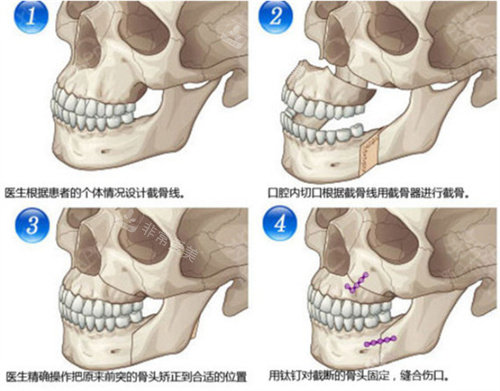 下頜骨矢狀劈開術(shù)手術(shù)步驟演示圖
