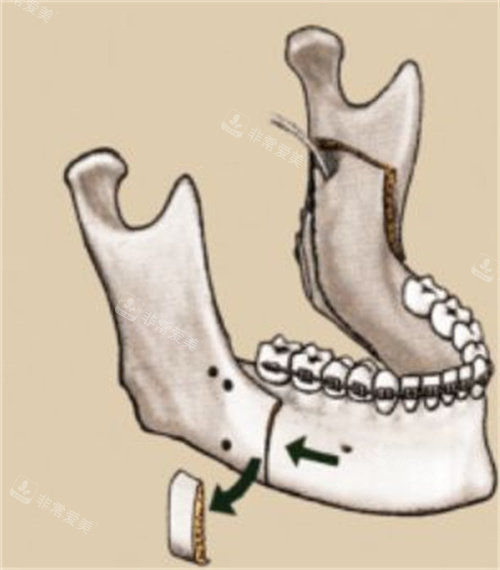 下颌垂直截骨术演示动画图