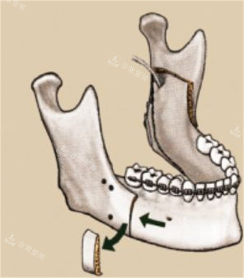 下頜垂直截骨術(shù)演示動畫圖