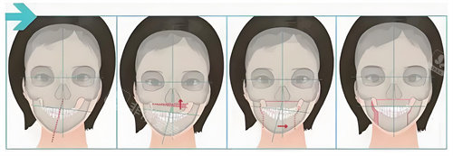 正颌手术手术步骤展示动画图
